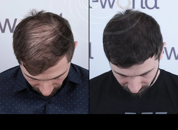 hair-before-after0