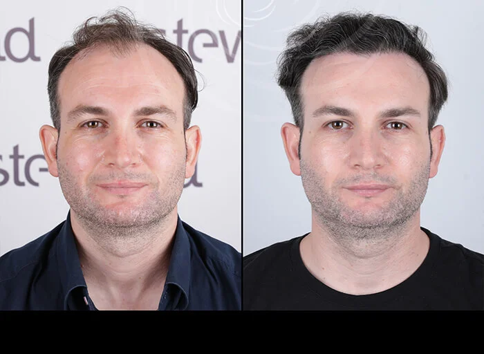 hair-before-after1
