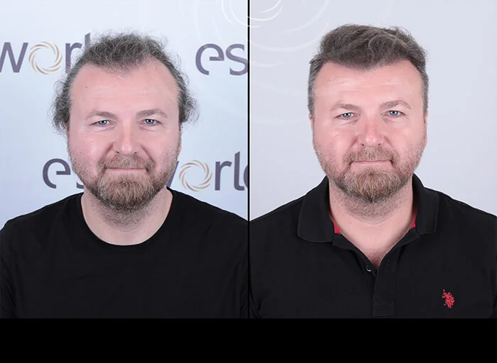 hair-before-after10