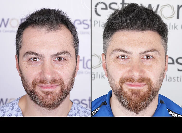 hair-before-after11