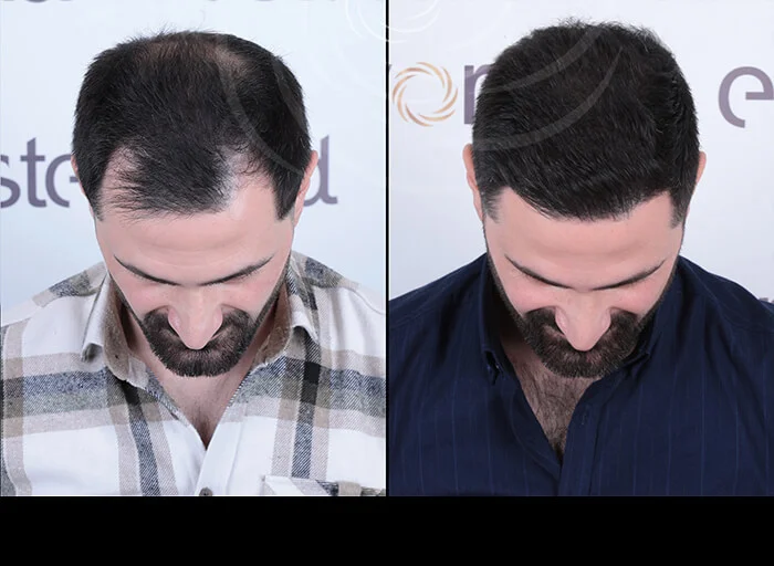 hair-before-after12
