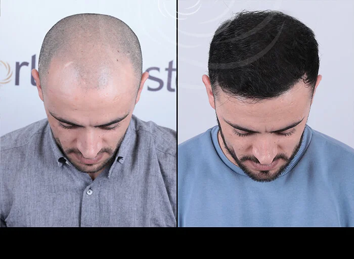 hair-before-after14