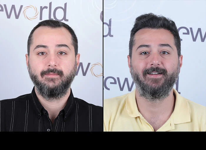 hair-before-after15