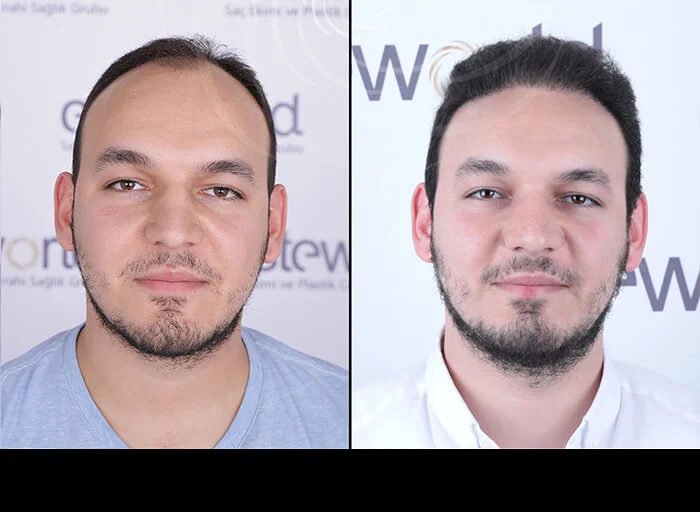 hair-before-after16