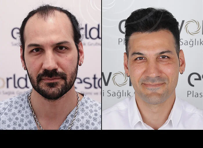 hair-before-after17