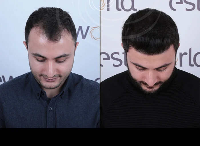 hair-before-after2