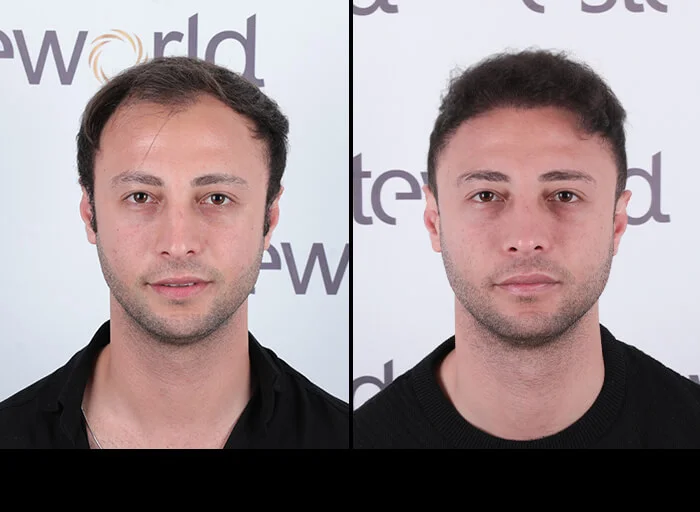 hair-before-after20