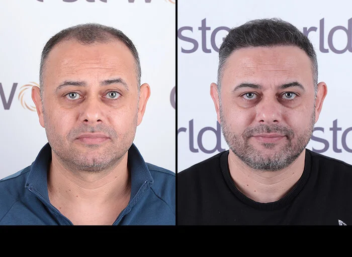 hair-before-after22