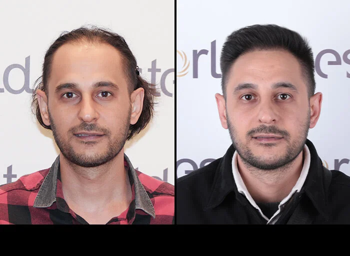 hair-before-after23
