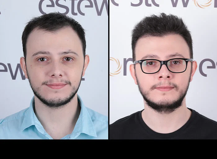 hair-before-after24