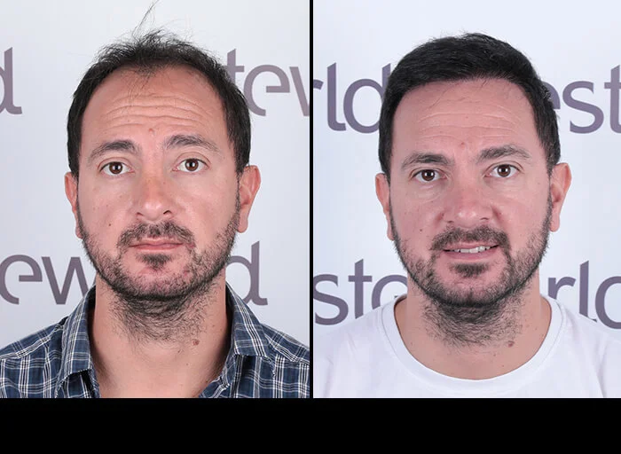 hair-before-after25