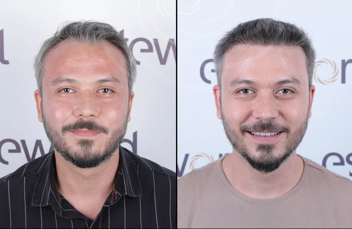 hair-before-after26
