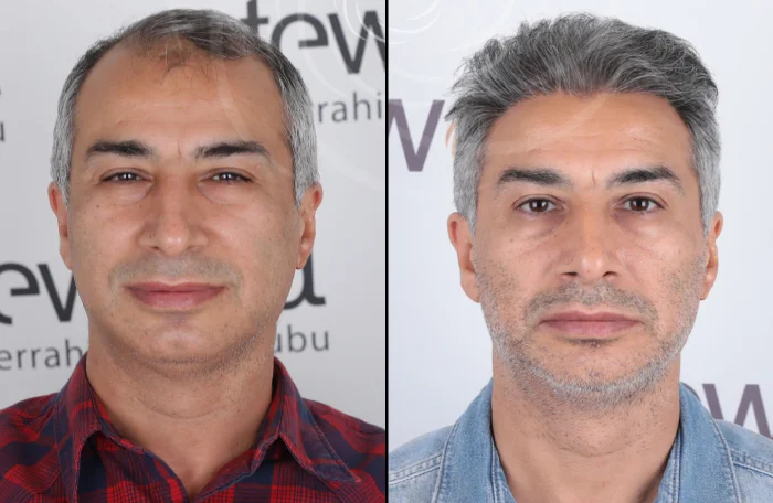 hair-before-after27