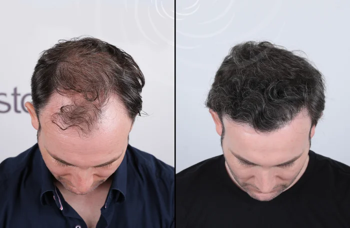 hair-before-after29
