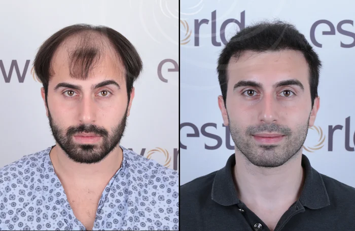 hair-before-after30