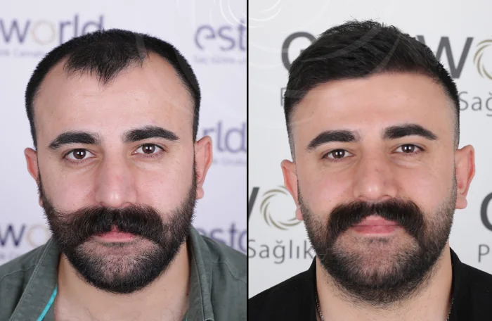 hair-before-after31