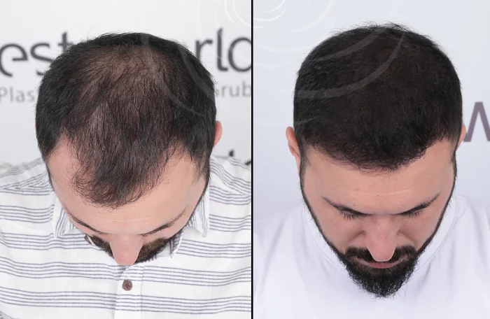 hair-before-after32