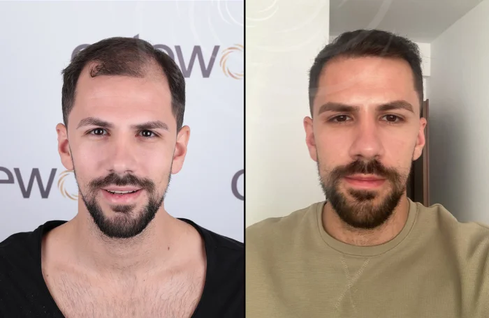 hair-before-after33
