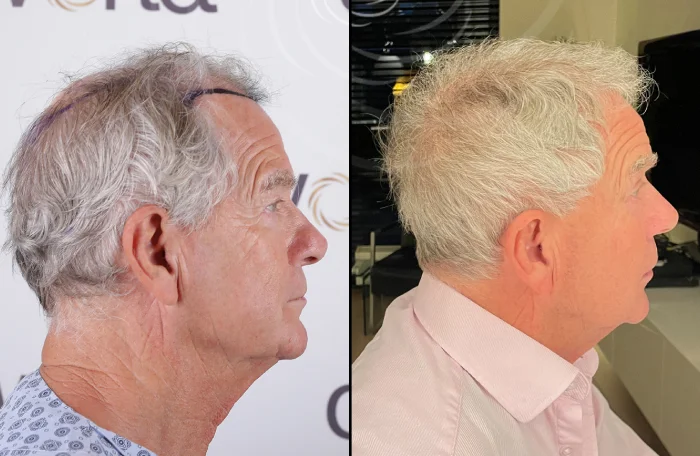 hair-before-after35
