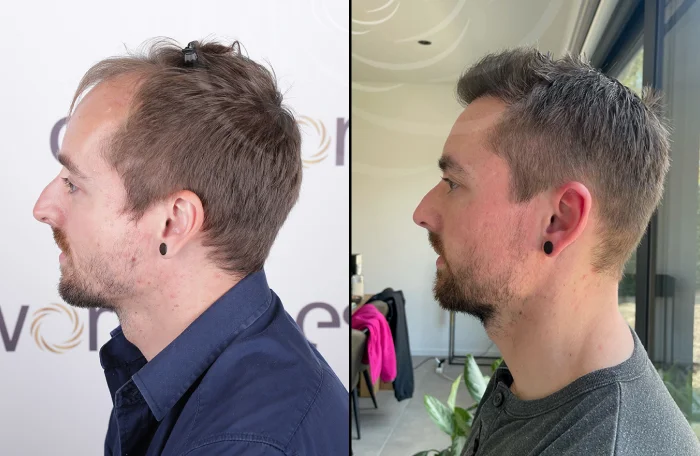 hair-before-after37