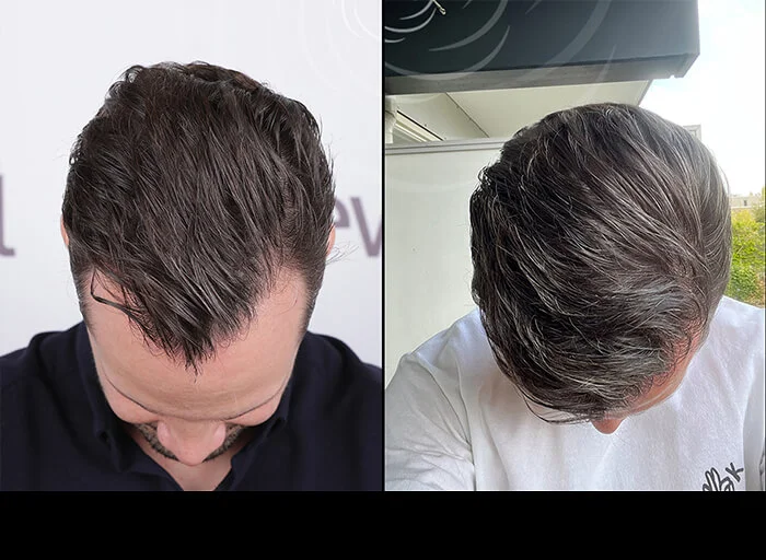 hair-before-after4