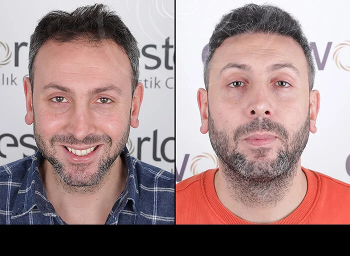 hair-before-after7