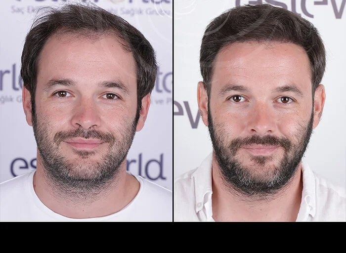 hair-before-after8