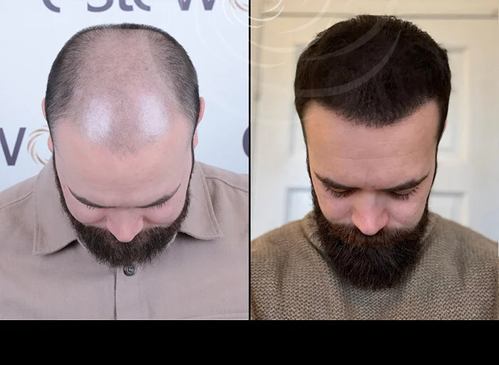 hair-before-after9