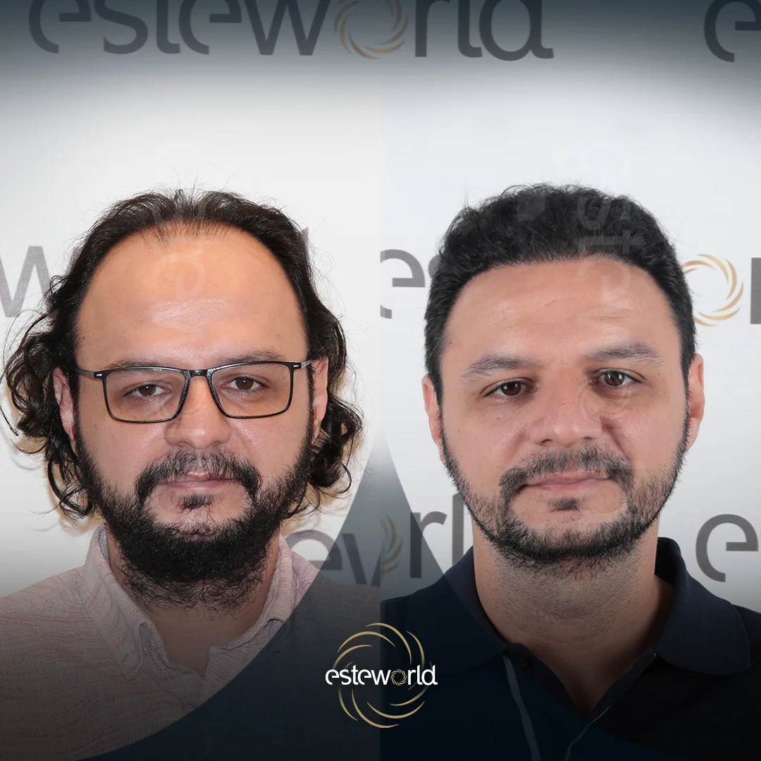 hair-before-after0