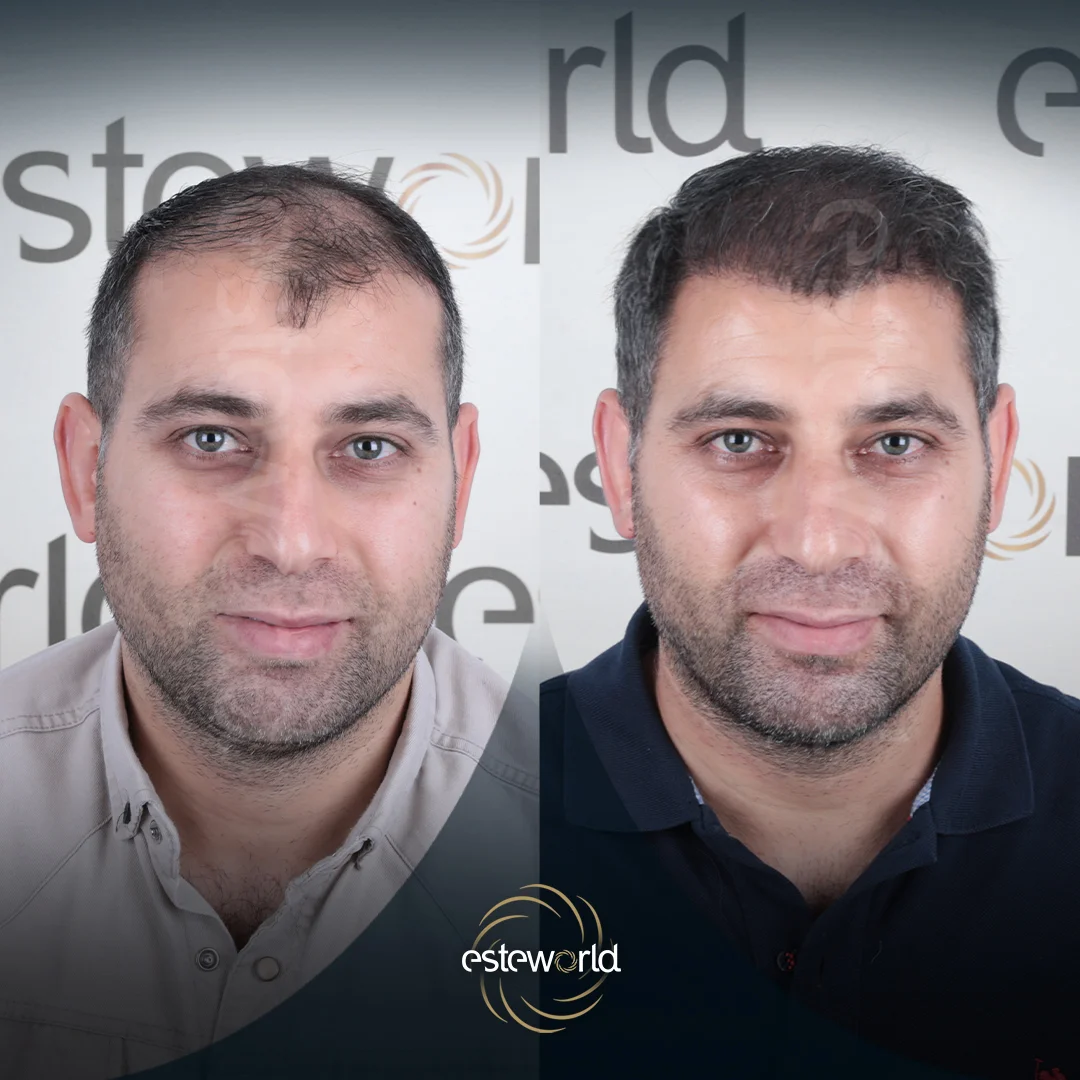 hair-before-after1