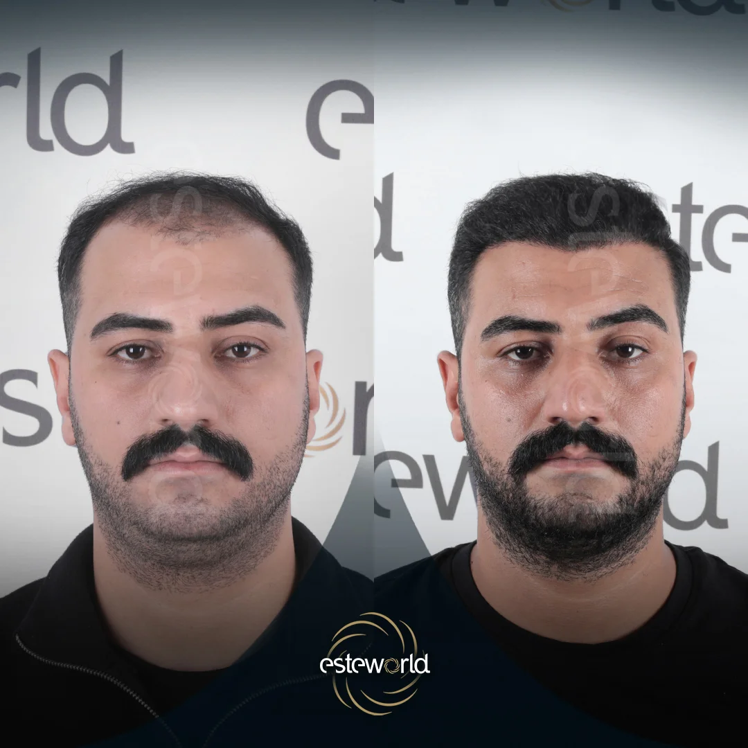 hair-before-after10
