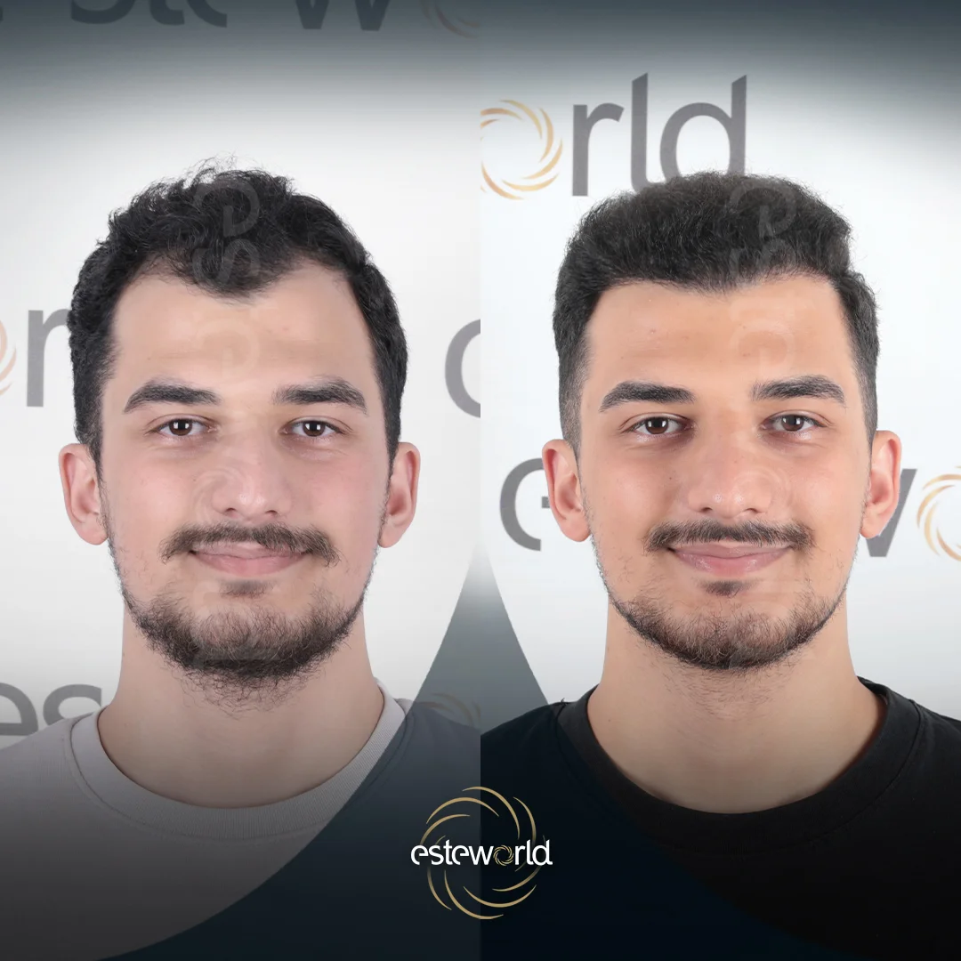 hair-before-after11