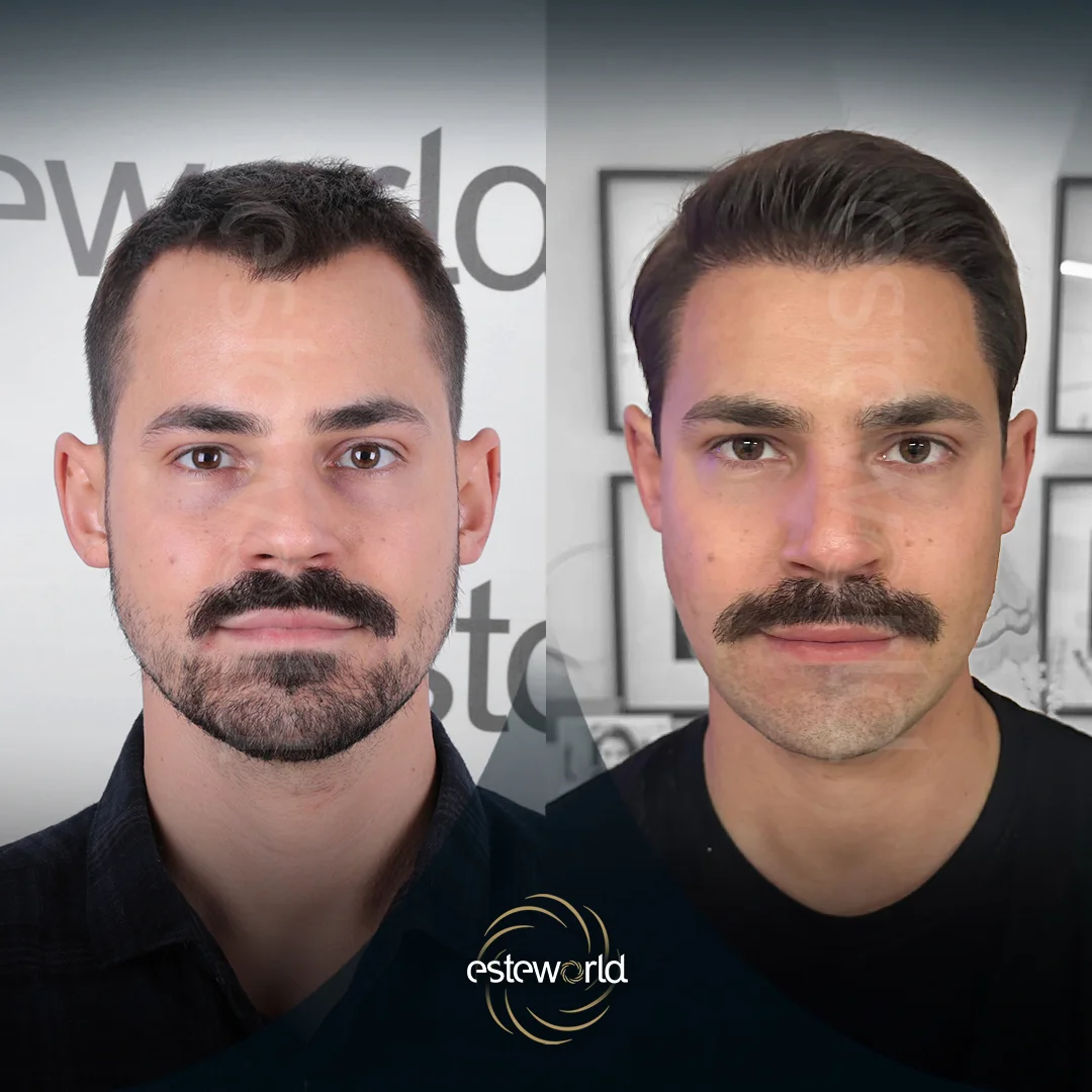 hair-before-after12