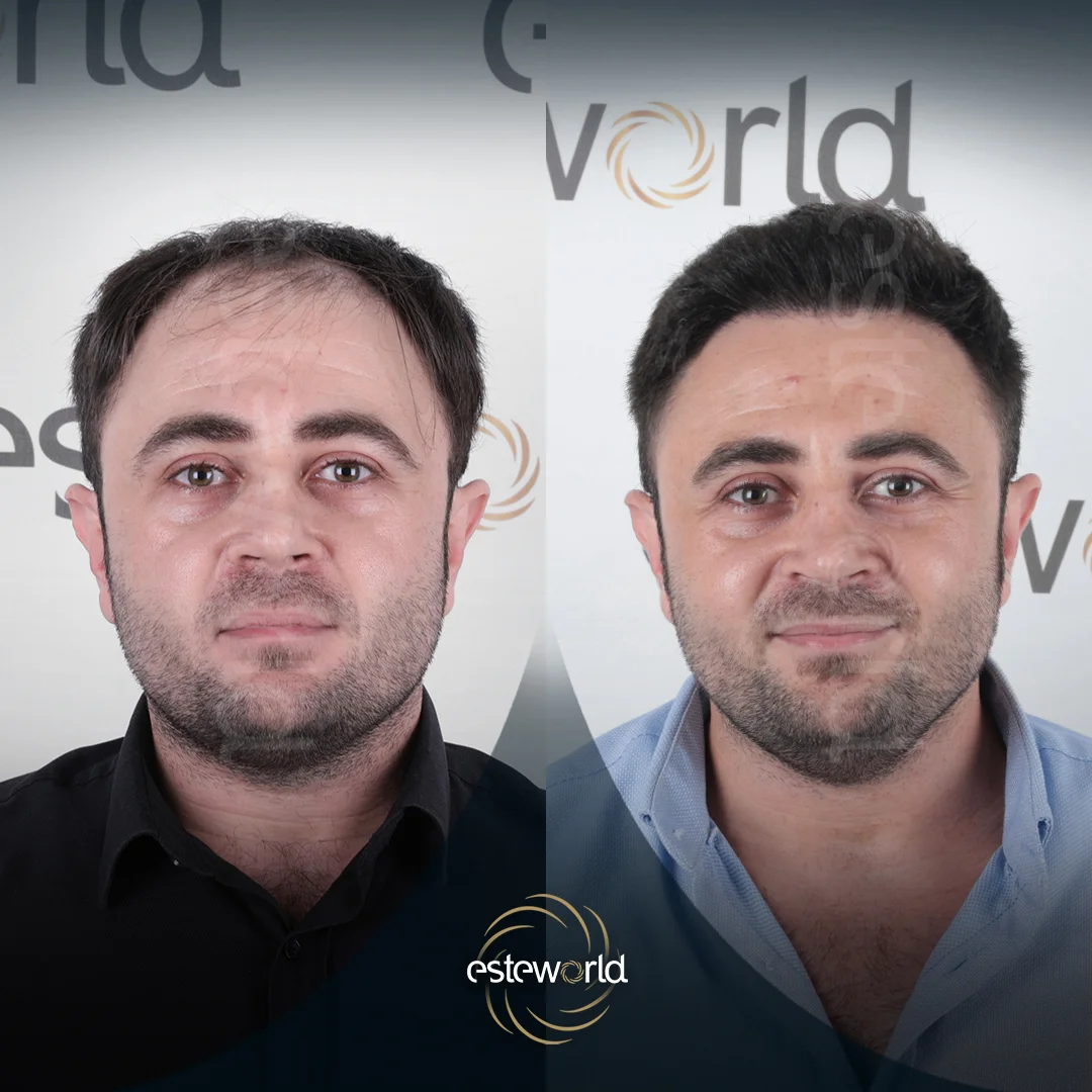 hair-before-after13