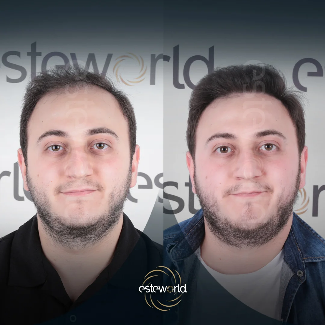 hair-before-after14
