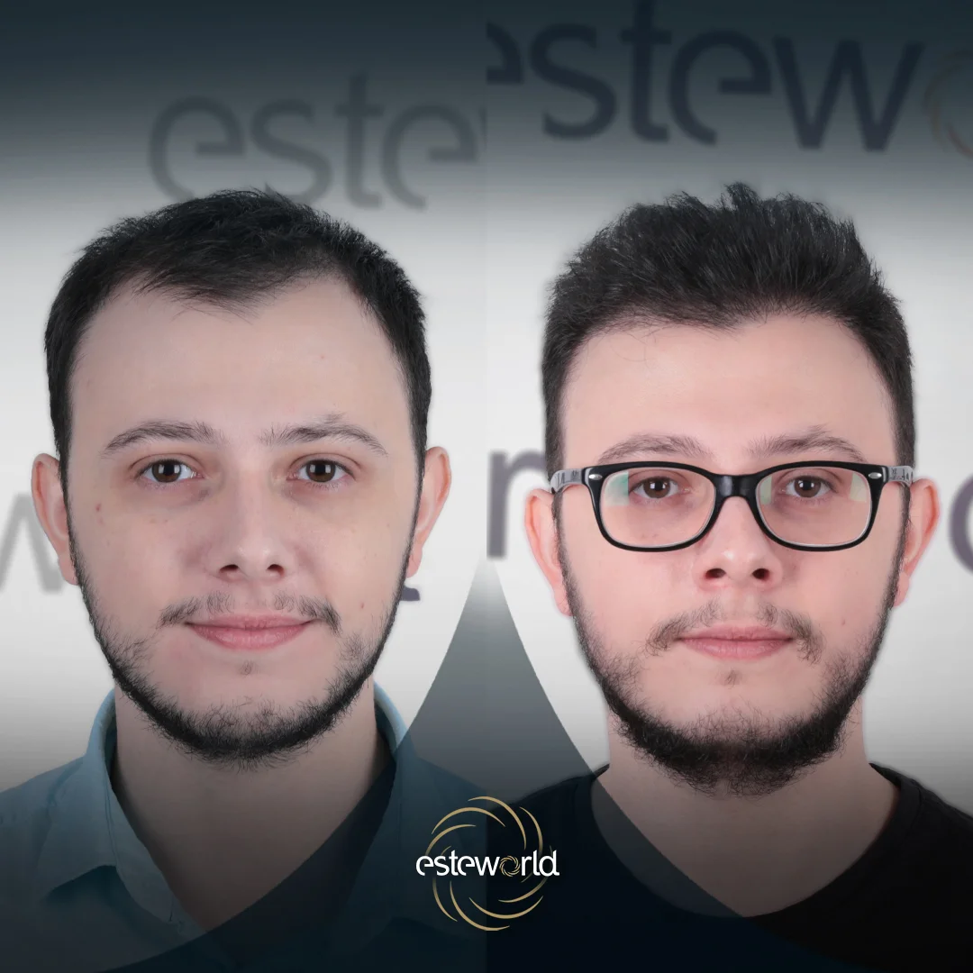 hair-before-after15