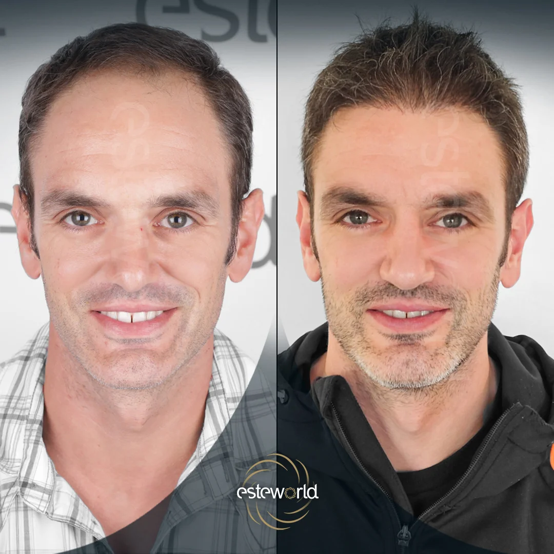 hair-before-after16