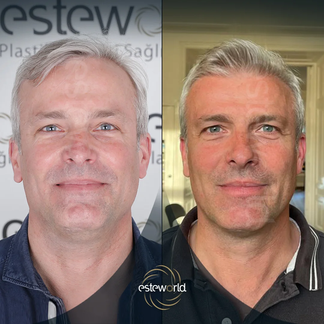 hair-before-after17