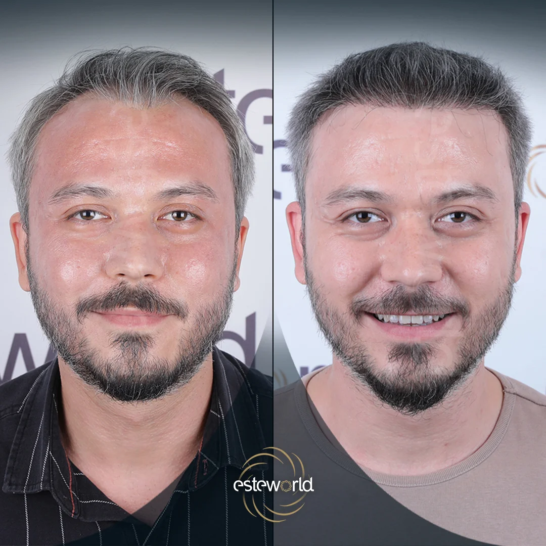 hair-before-after18
