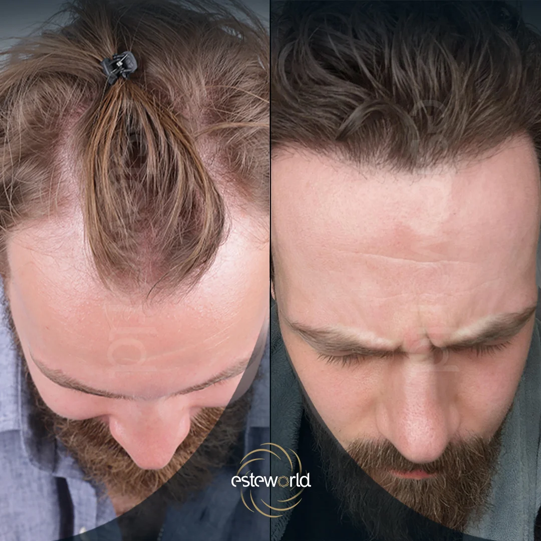hair-before-after19