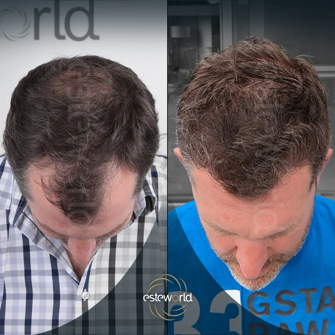 hair-before-after20