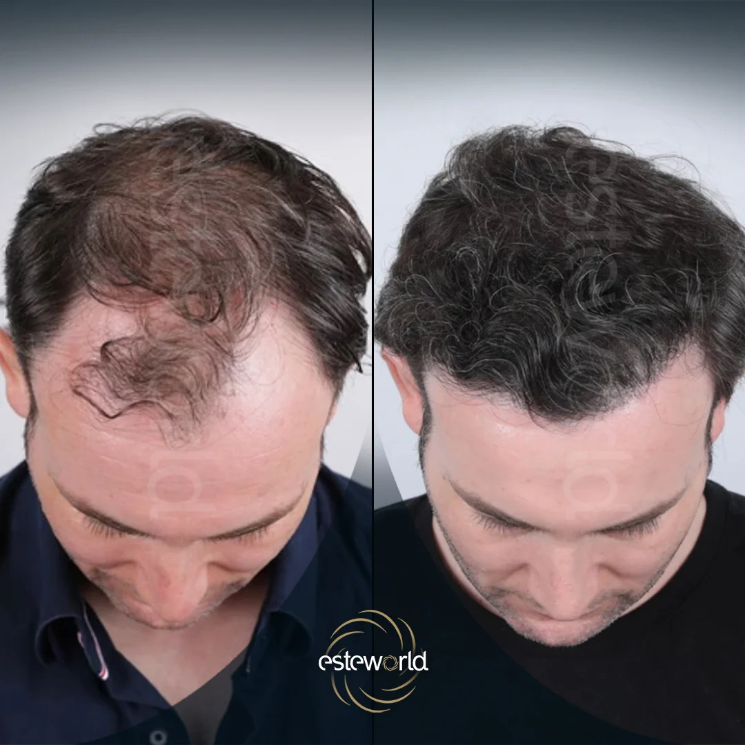 hair-before-after21