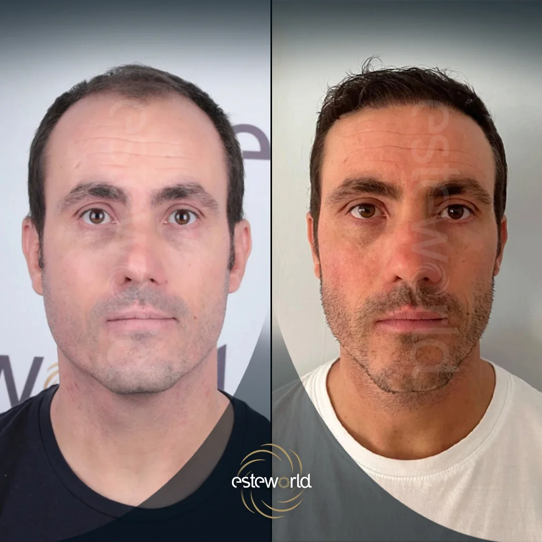 hair-before-after22