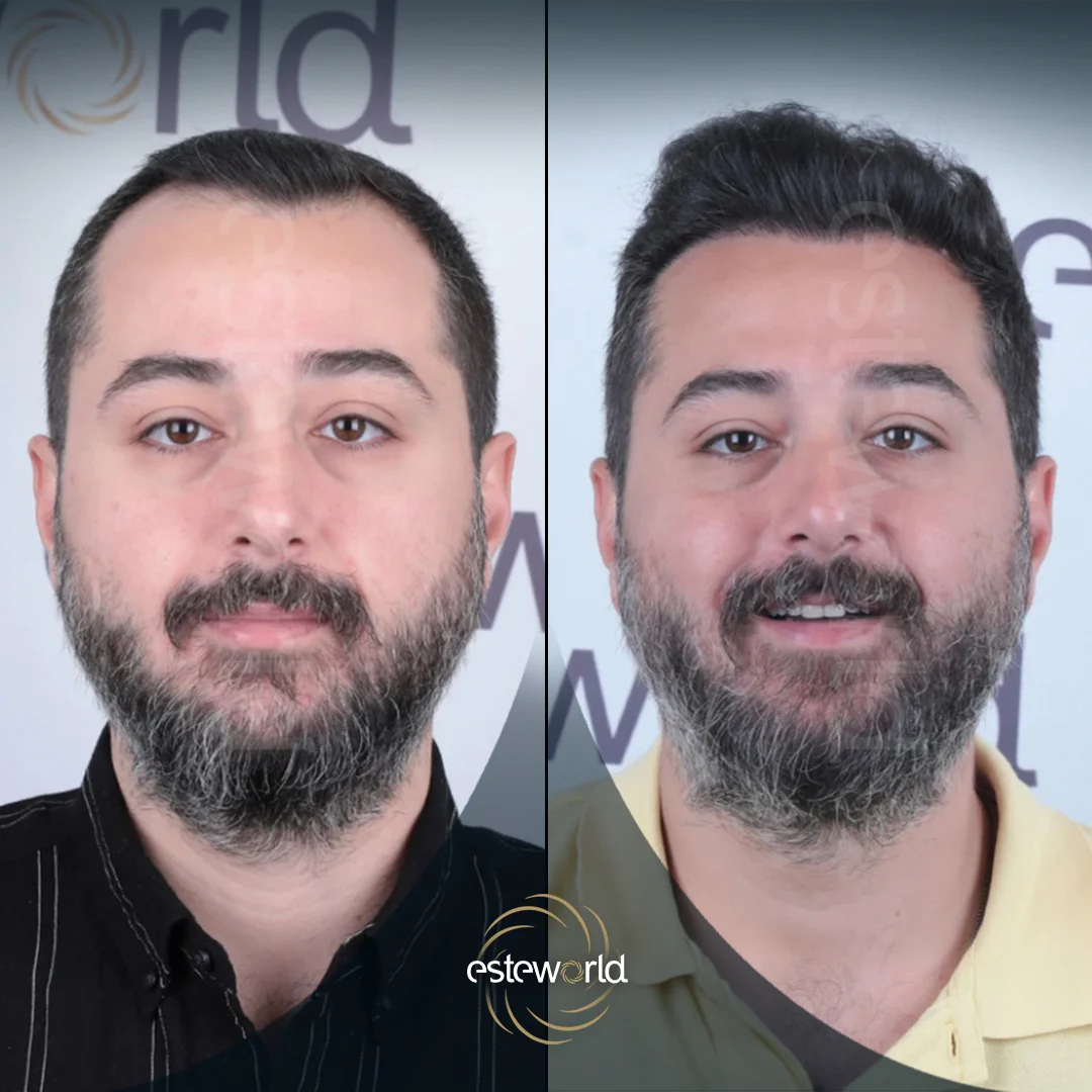 hair-before-after23