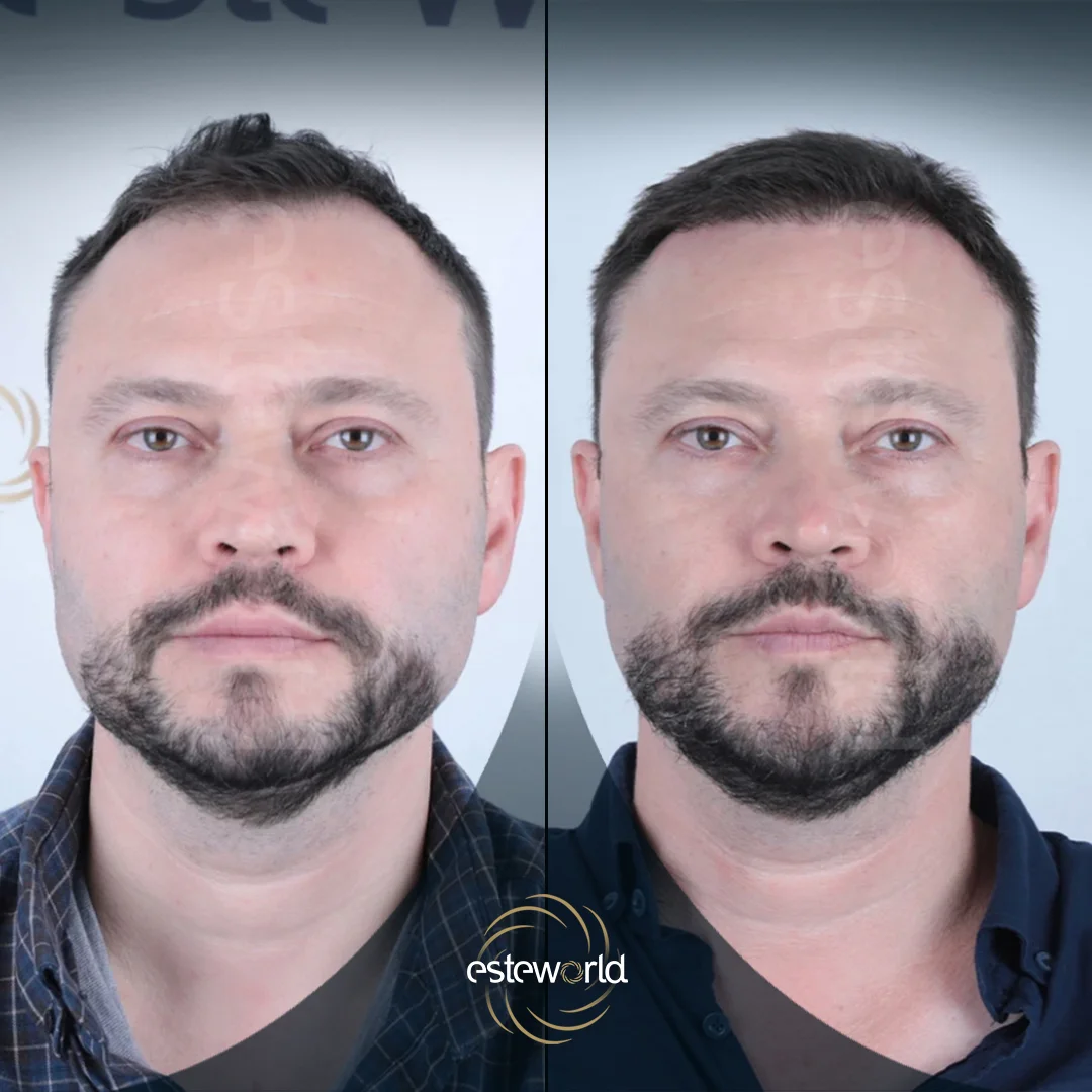 hair-before-after24
