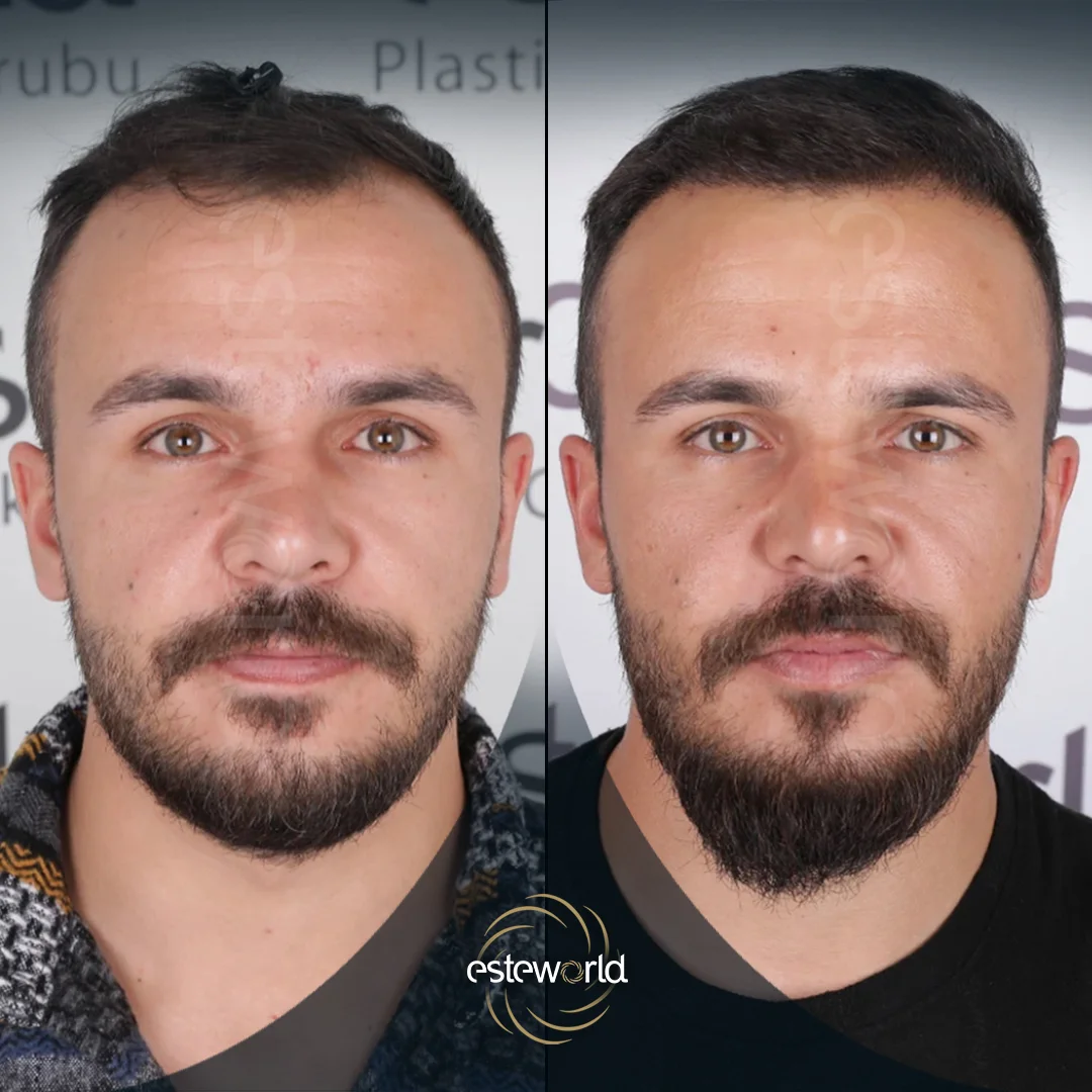 hair-before-after25