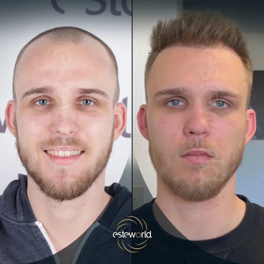 hair-before-after26