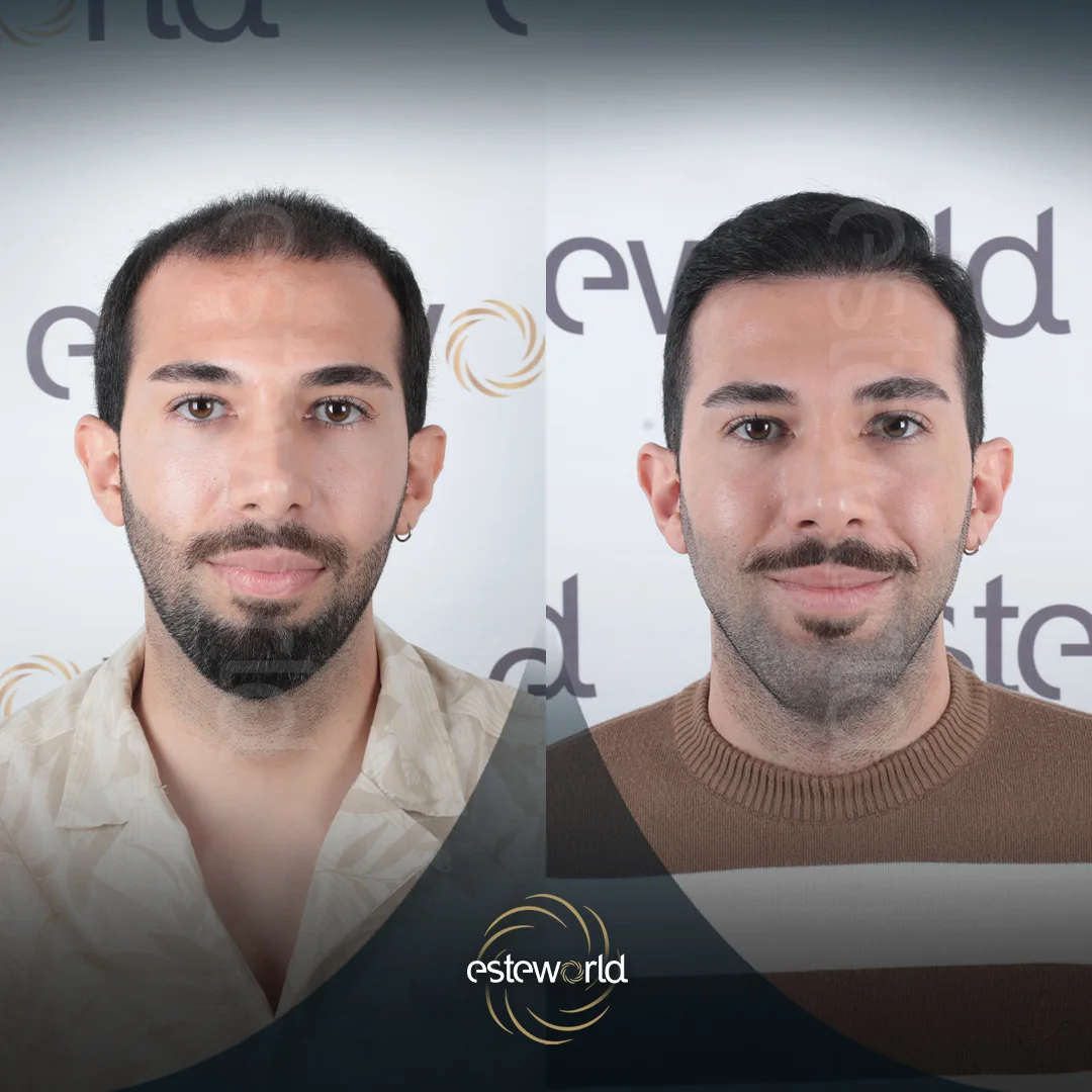 hair-before-after27