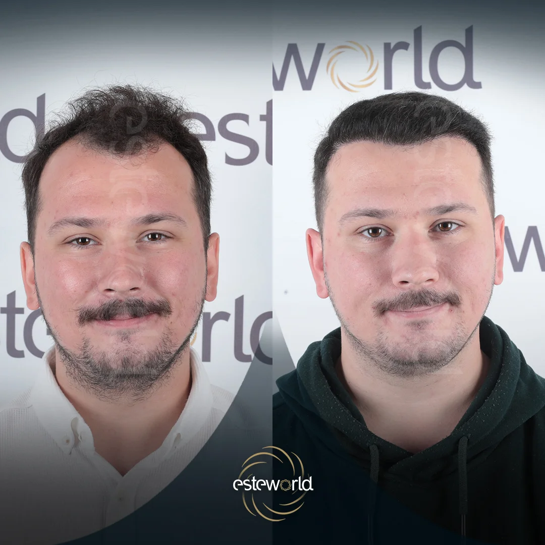 hair-before-after28