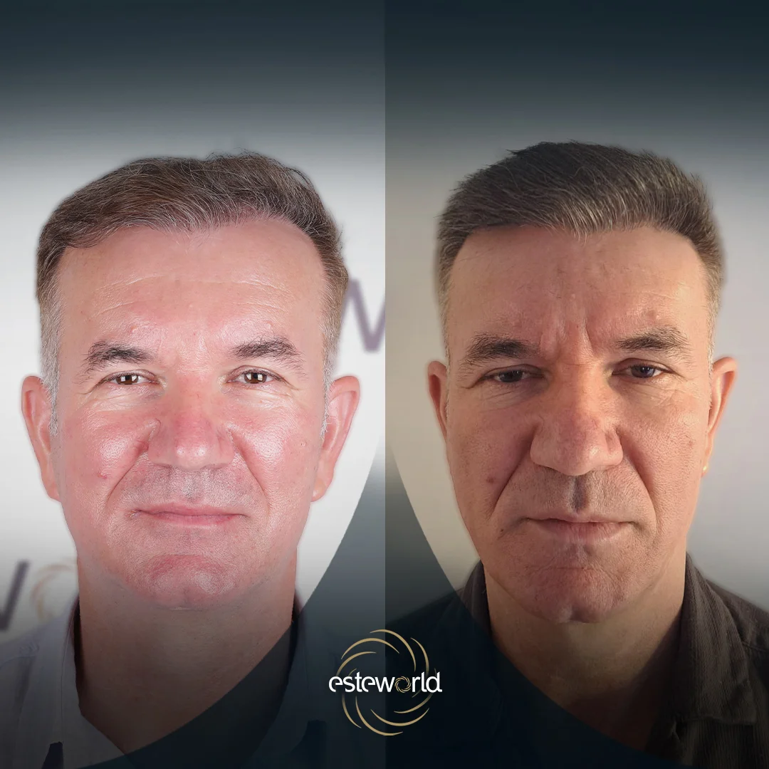 hair-before-after29